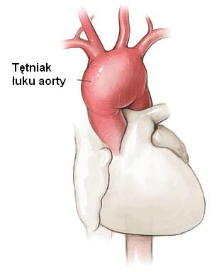 tętniak łuku aorty